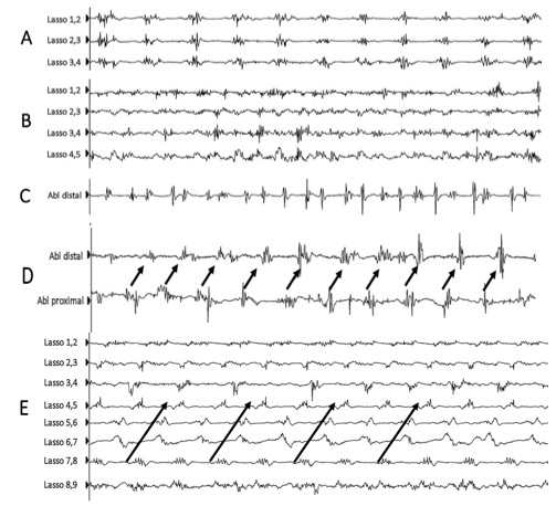 Abstract 1024 Targeted ablation of specific electrogram patterns in low ...