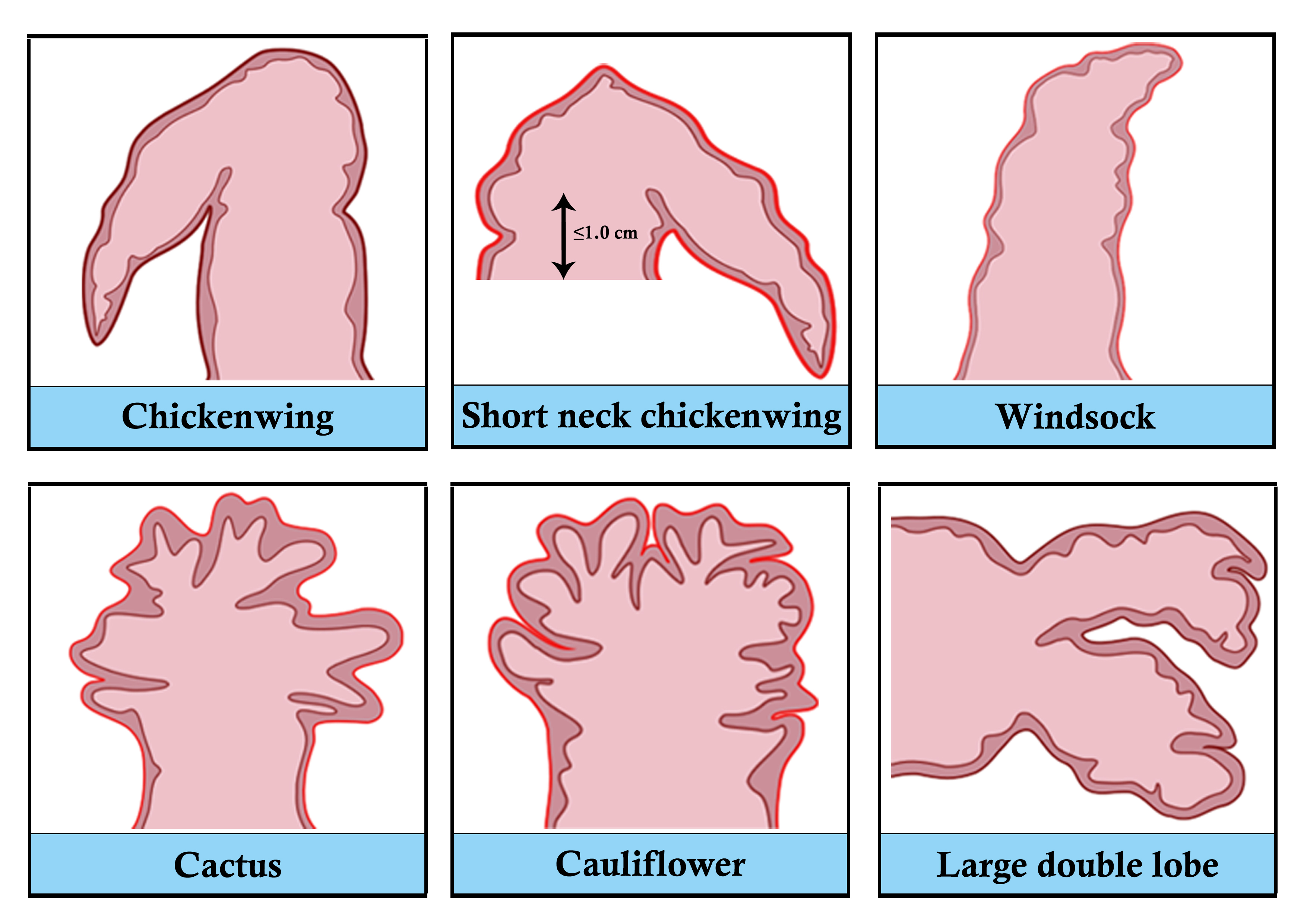 Abstract 1306 Impact of left atrial appendage morphology on procedural