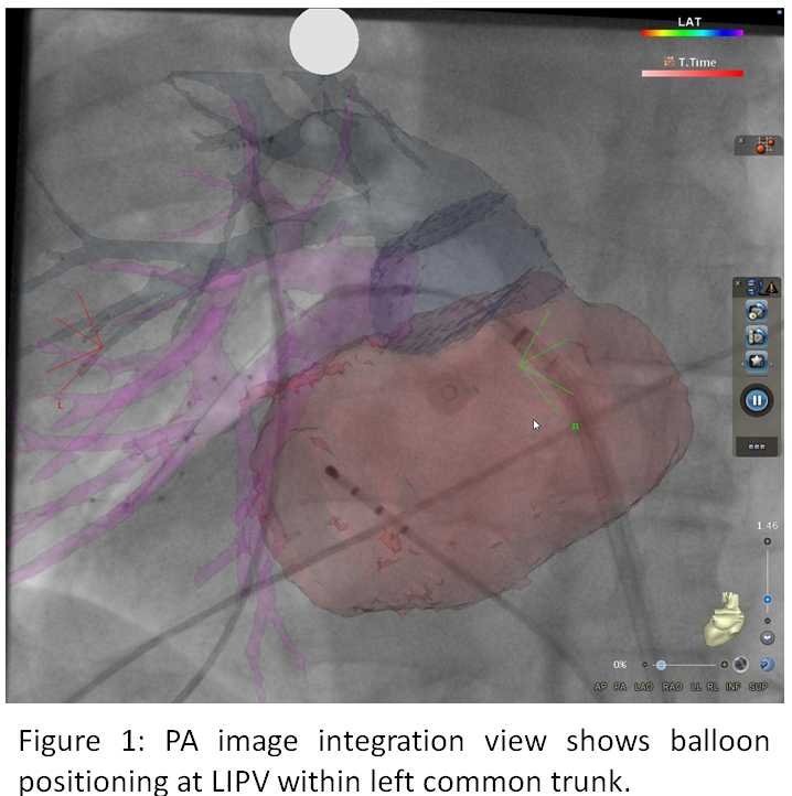 Abstract 990 3D image integration guidance for Cryo Balloon Pulmonary ...