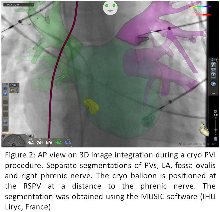 Abstract 990 3D image integration guidance for Cryo Balloon Pulmonary ...