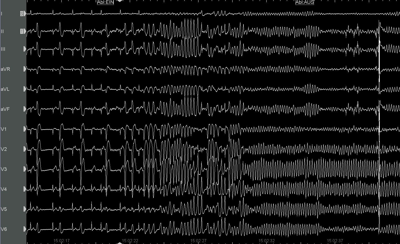 Abstract 232 A case report: Idiopathic Right Ventricular Outflow  Extrasystolie - Not as benign as we think ?