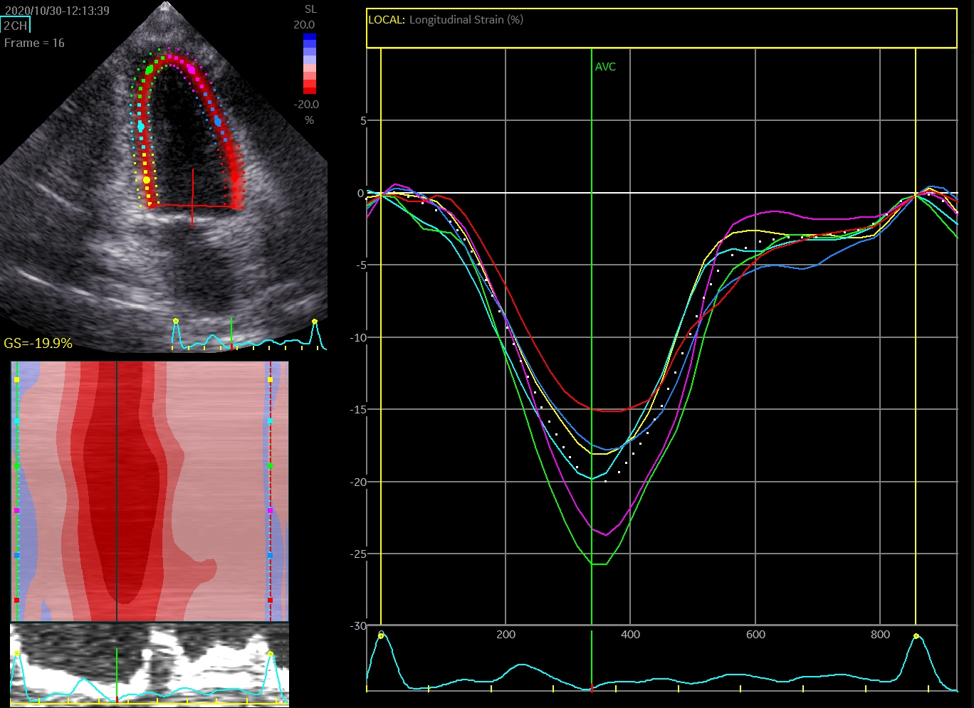 Global longitudinal strain from speckle tracking echocardiography. The